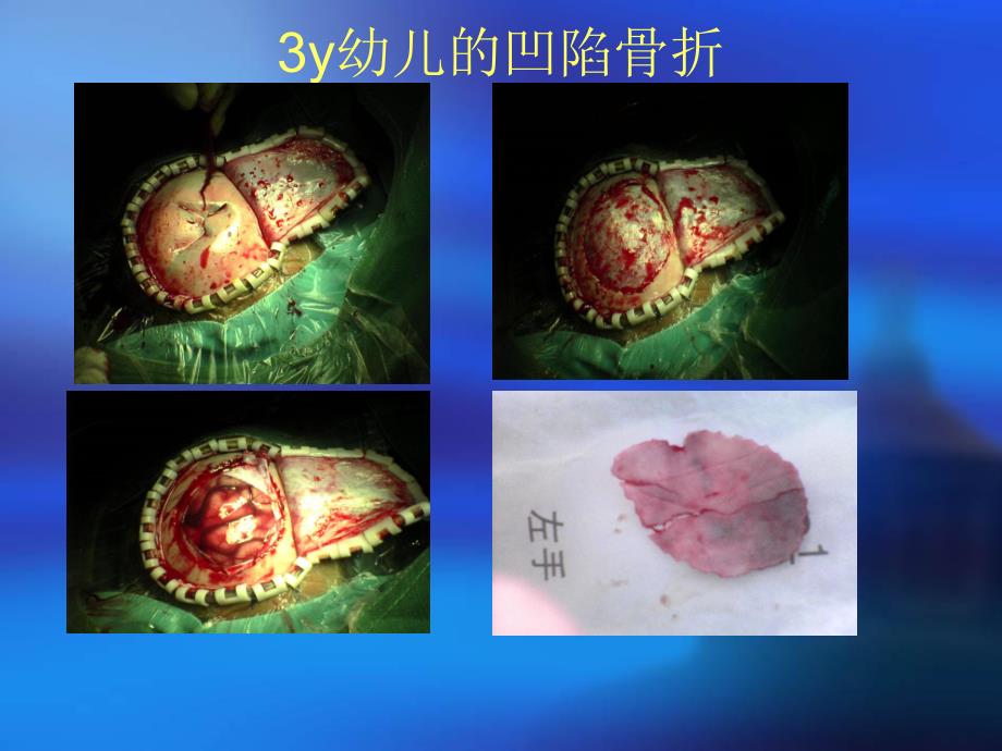 脑外科科技进步数字化颅骨修补技术.ppt_第3页