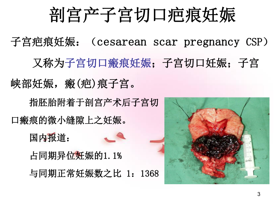 3.疤痕妊娠的影像学诊断姚穗.ppt_第3页