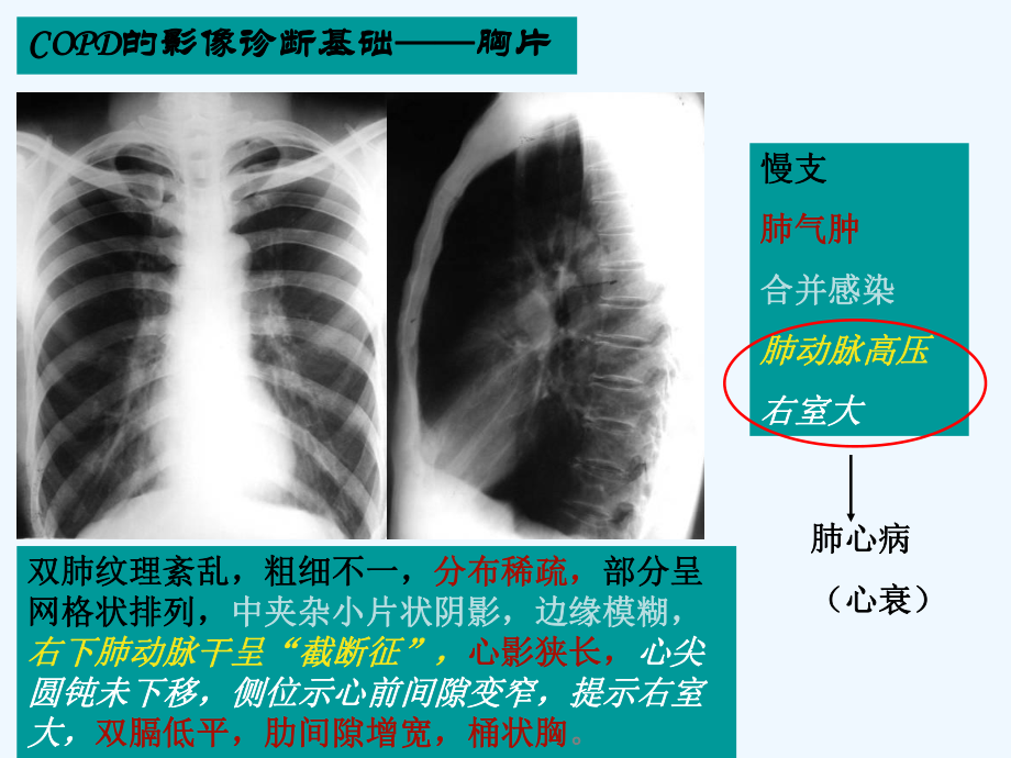 COPD的影像学诊断.ppt_第3页