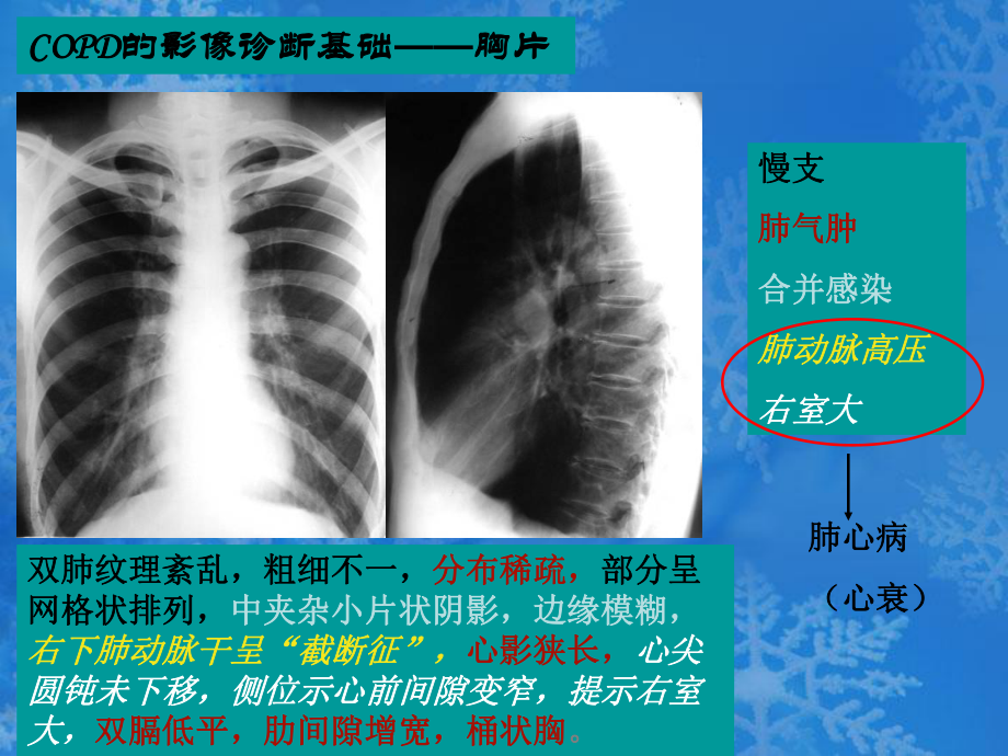 COPD的影像学诊断.ppt_第3页