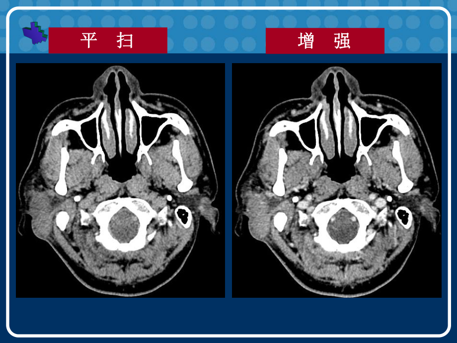 木村病影像学病例讨论(CT).ppt_第3页