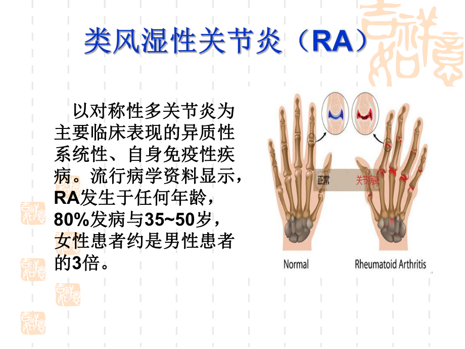 类风湿性关节炎的健康教育.ppt_第2页