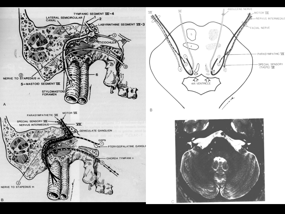 面神经的影像学诊断.ppt_第3页