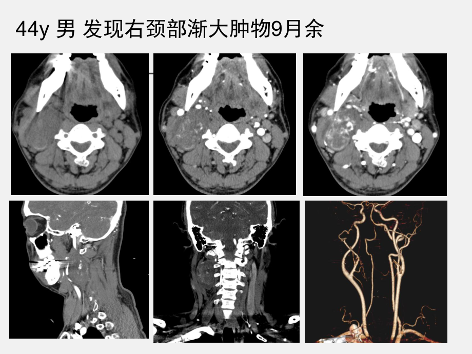 颈动脉体瘤影像学诊断.ppt_第1页