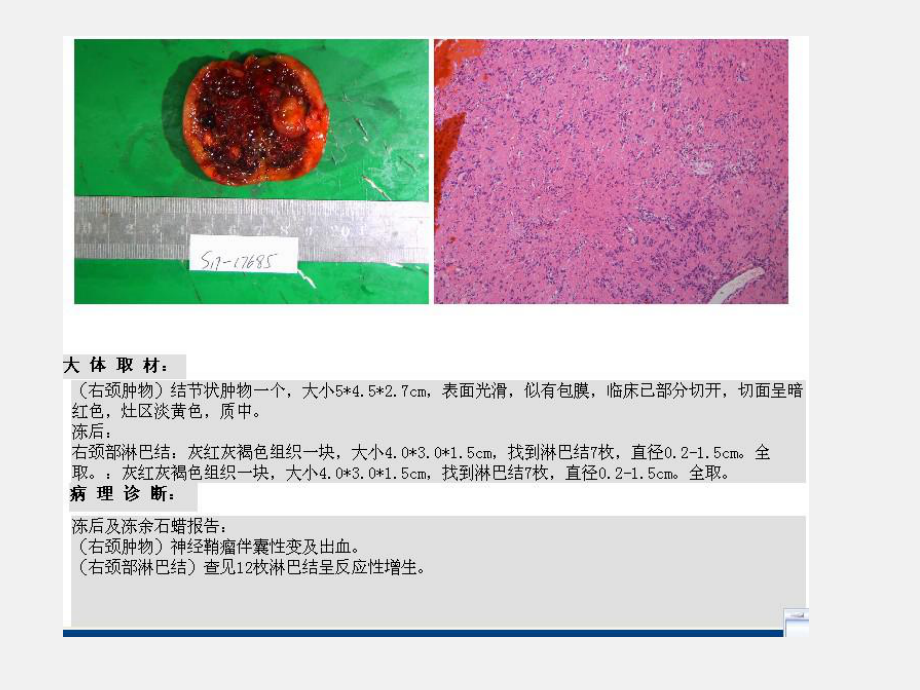 颈动脉体瘤影像学诊断.ppt_第3页