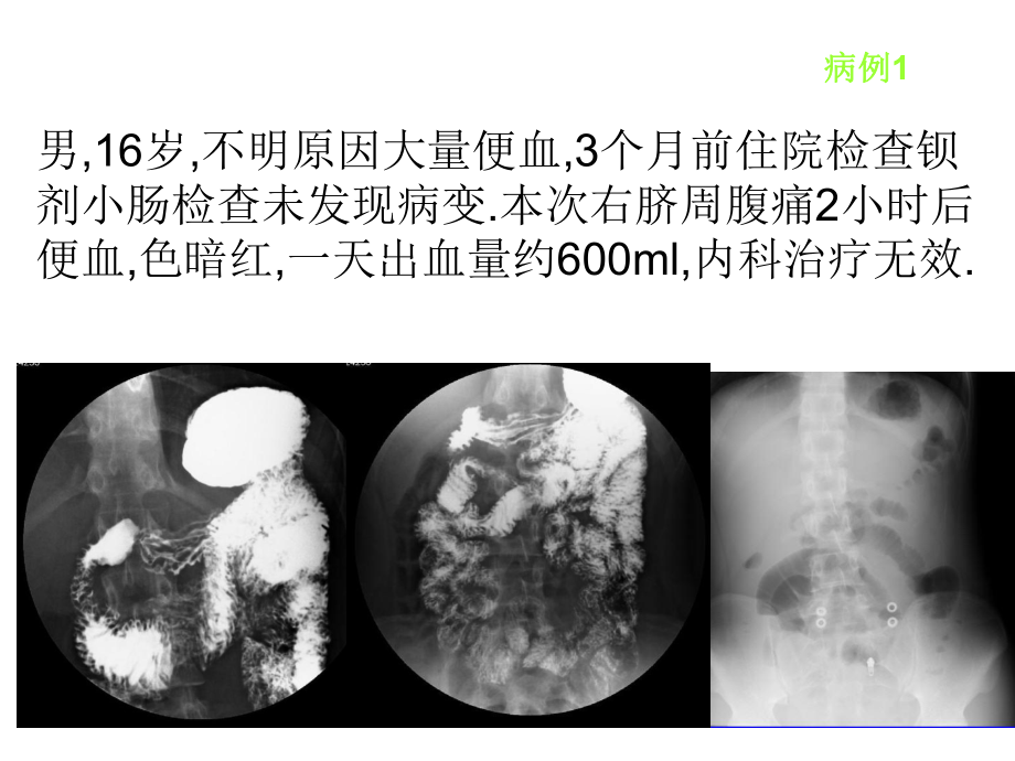 麦克尔憩室的影像学诊断1.ppt_第1页