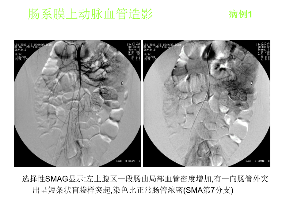 麦克尔憩室的影像学诊断1.ppt_第2页