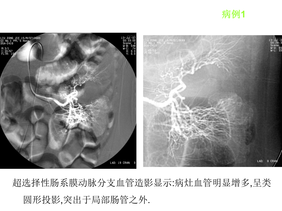 麦克尔憩室的影像学诊断1.ppt_第3页