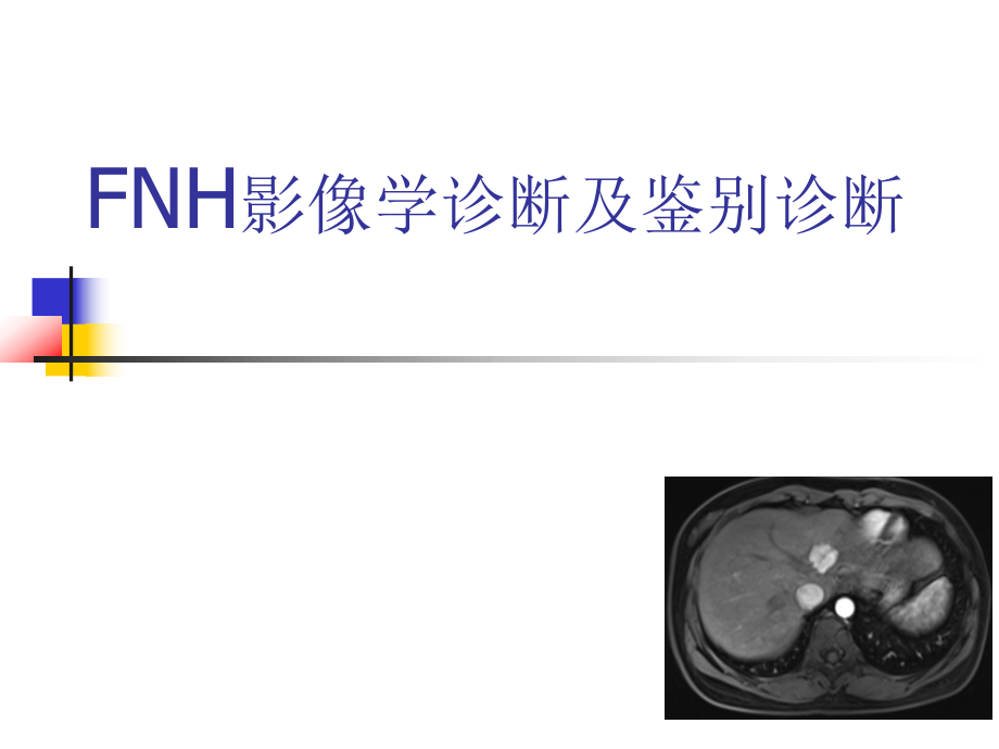 FNH影像学诊断及鉴别诊断.ppt_第1页