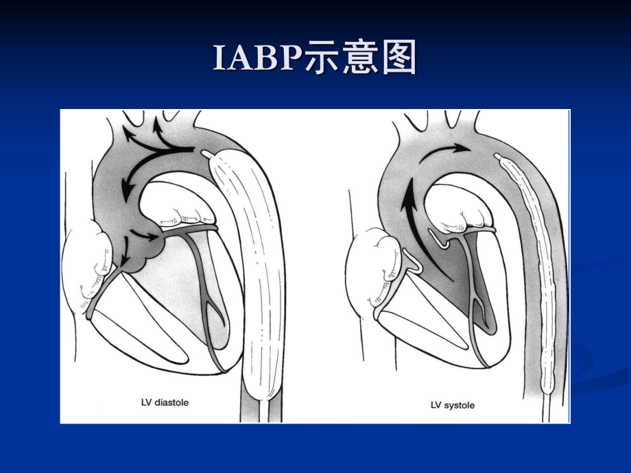 IABP临床应用.ppt_第3页