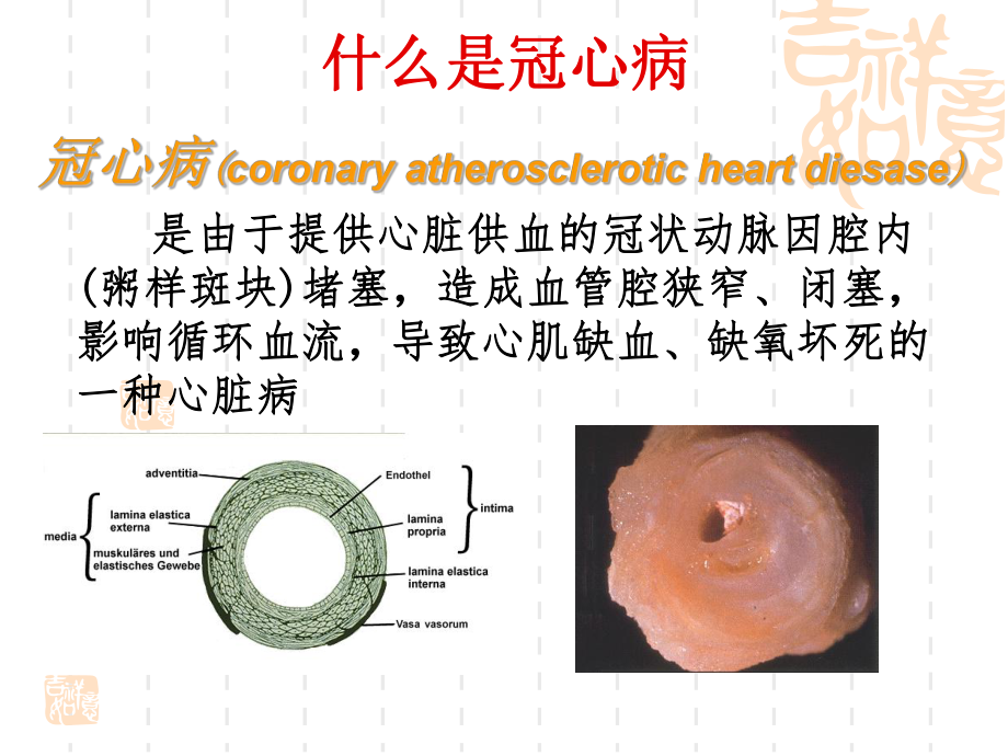 冠心病的介入治疗ppt.ppt_第2页