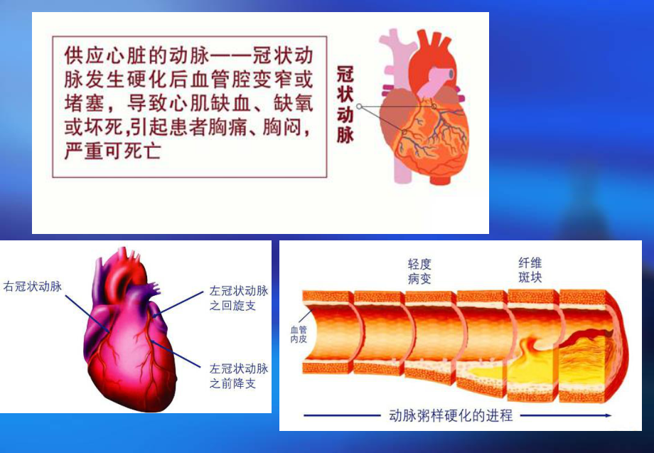 冠心病的康复.ppt_第3页