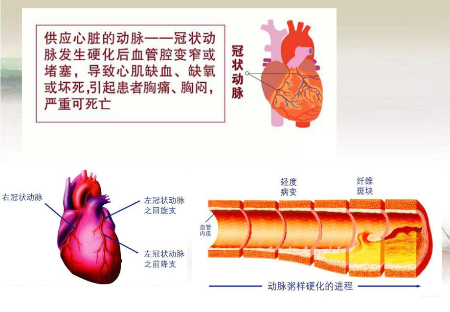 冠心病的康复PPT.ppt_第3页