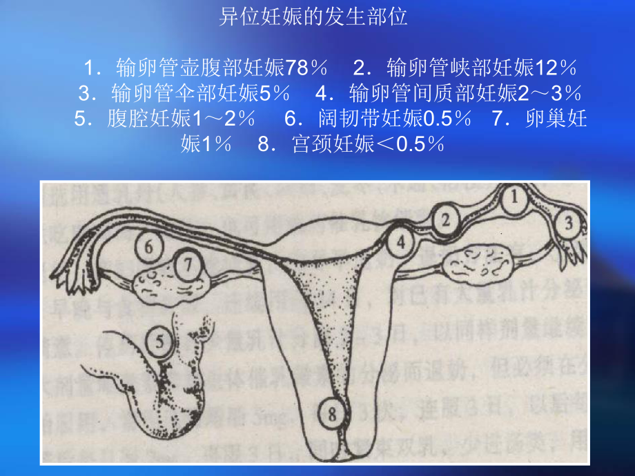 异位妊娠(课件).ppt_第3页