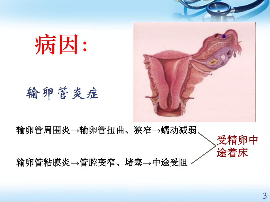 宫外孕的护理医学PPT课件.ppt_第3页