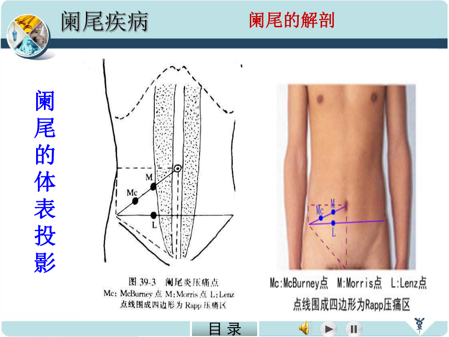 急性阑尾炎精品医学PPT课件.ppt_第3页