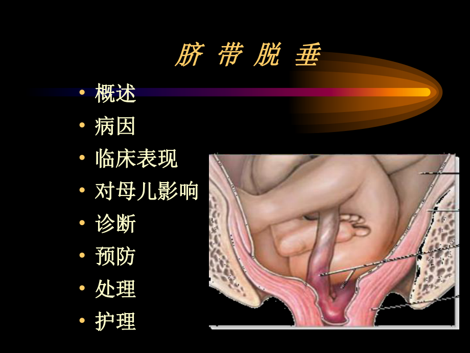 脐带脱垂课件.ppt_第2页