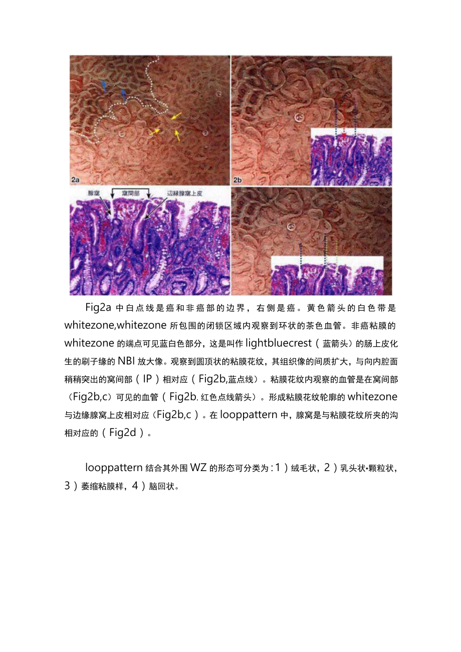 医学美图：八木胃早癌理论（分化癌）.docx_第3页