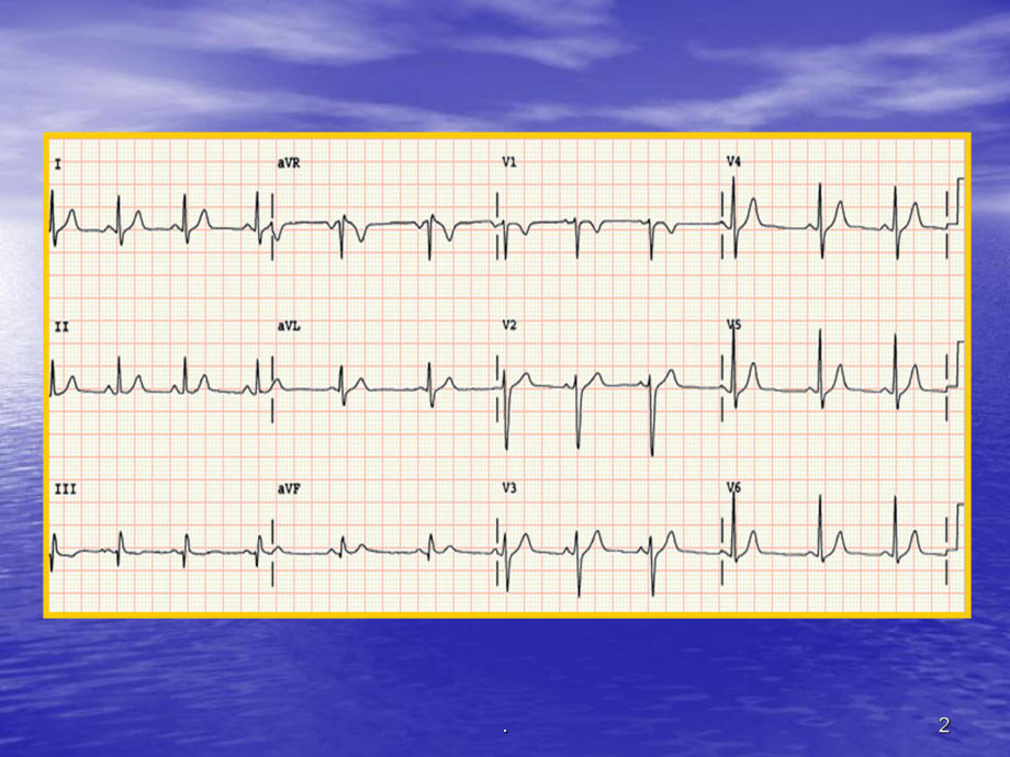 《心电图课件》PPT课件.ppt_第2页