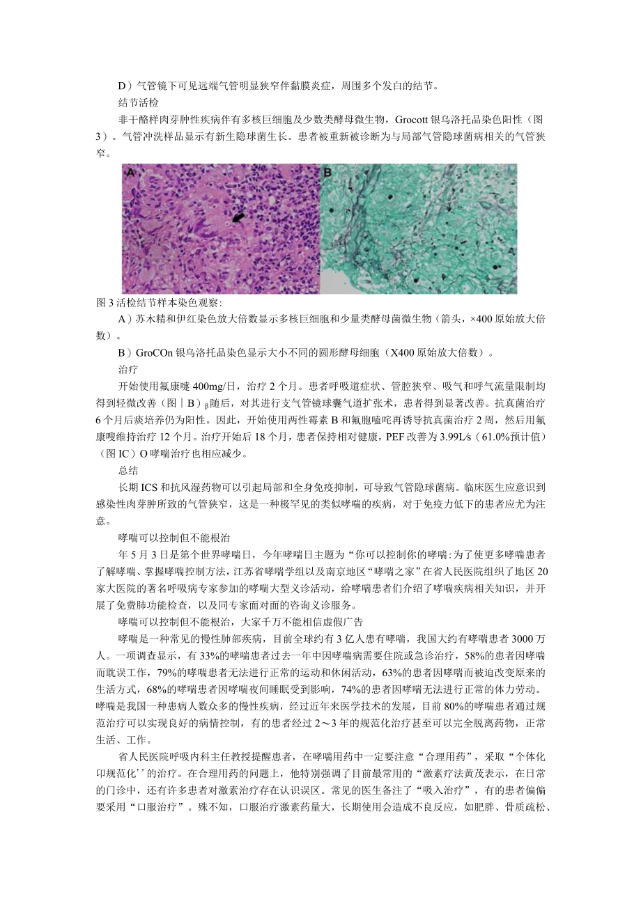 59岁女性患哮喘14年最近症状不能控制真实原因并不简单（附哮喘可以控制但不能根治）.docx_第2页