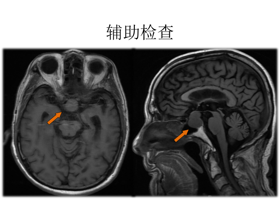 【医学课件】垂体占位PPT.pptx_第3页