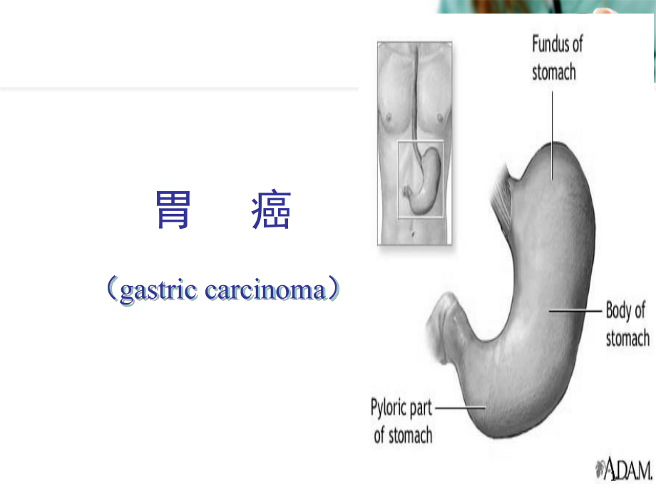 胃癌教学课件幻灯片课件.ppt_第1页