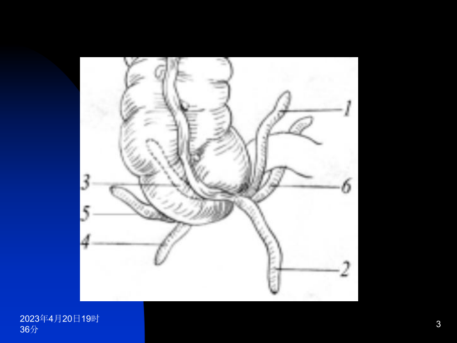 阑尾炎(中文)课件.ppt_第3页