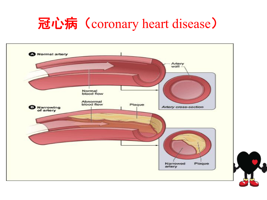 冠心病患者行非心脏手术的麻醉管理.pptx_第3页