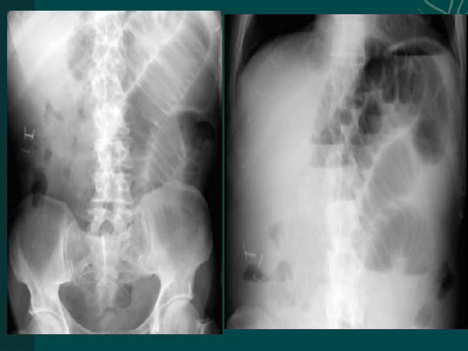 单纯性肠梗阻影像学分析.pptx_第2页