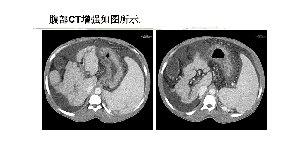 肝血吸虫病影像学病例讨论.pptx_第2页