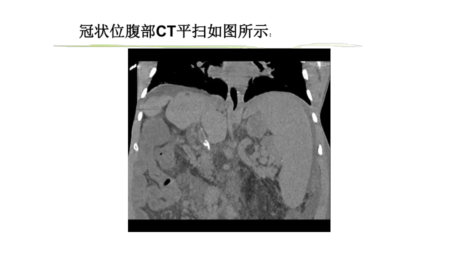 肝血吸虫病影像学病例讨论.pptx_第3页