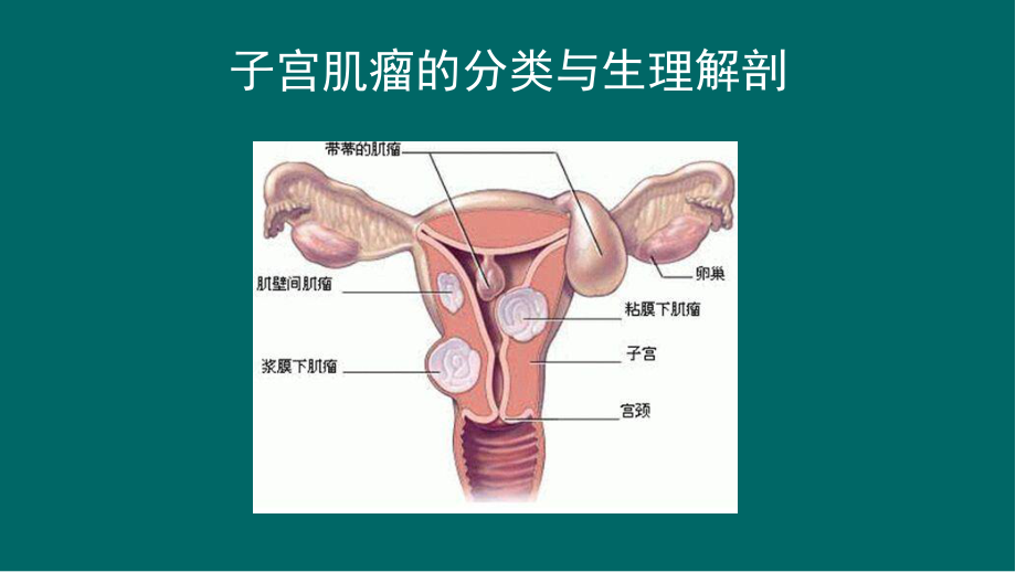 子宫肌瘤的护理查房ppt医学课件.pptx_第3页