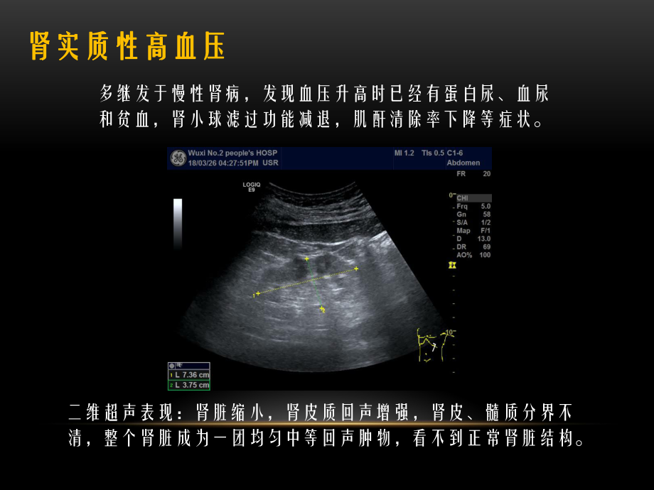 肾性高血压的超声诊断.pptx_第3页