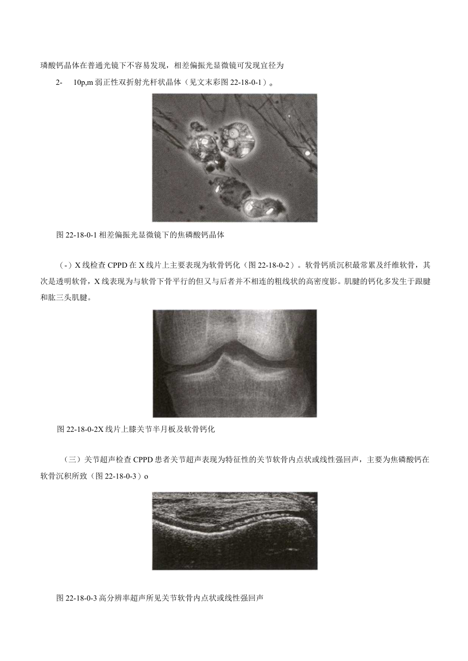 焦磷酸钙沉积性关节病诊疗规范2023版.docx_第2页