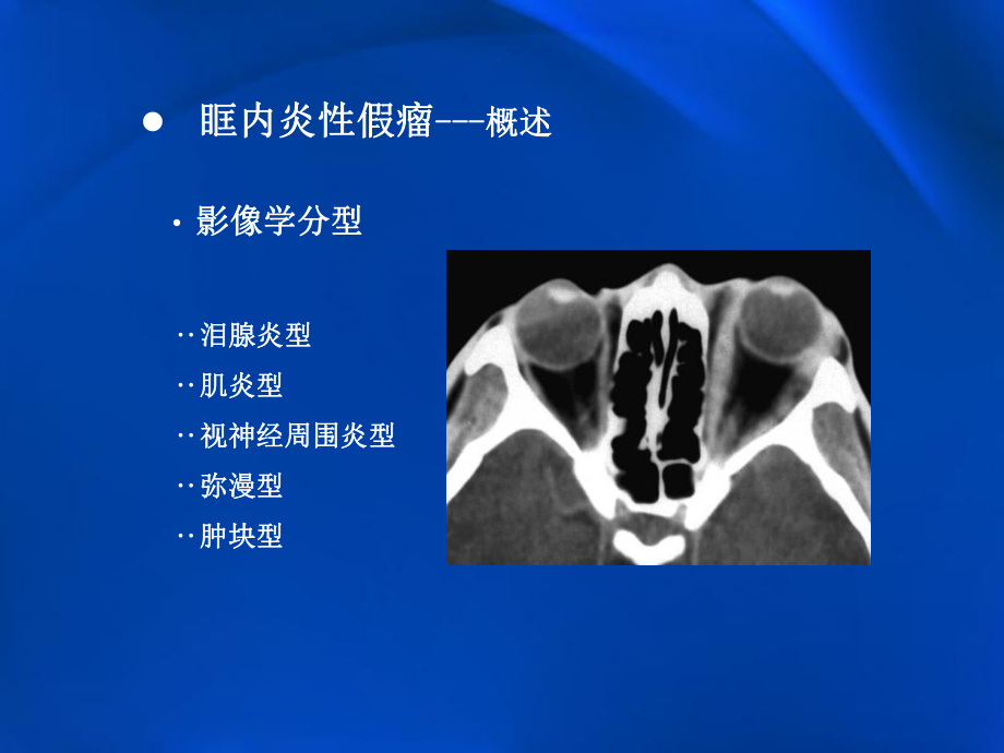 眶内炎性假瘤影像学.pptx_第3页