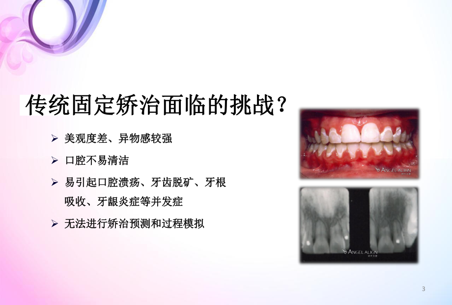 隐形矫正医学PPT课件.ppt_第3页