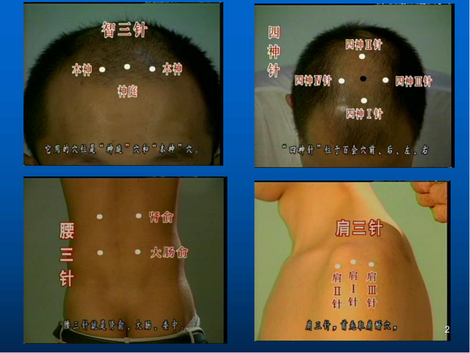 针灸教学医学PPT课件.ppt_第2页