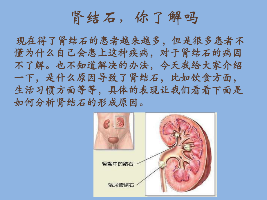 肾结石是怎么形成的.ppt_第2页