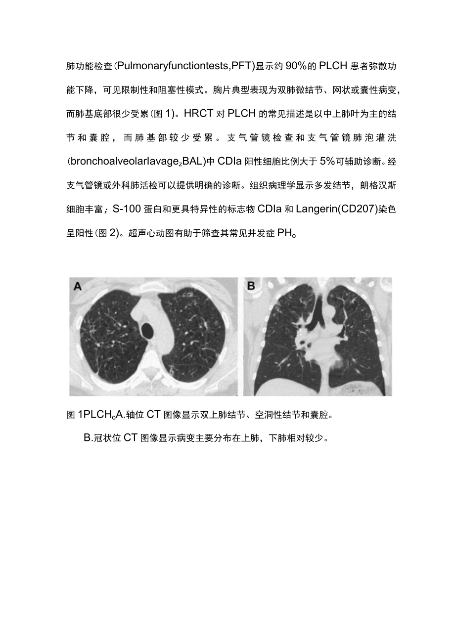 2023吸烟相关间质性肺疾病的临床表现、诊断及治疗（完整版）.docx_第2页