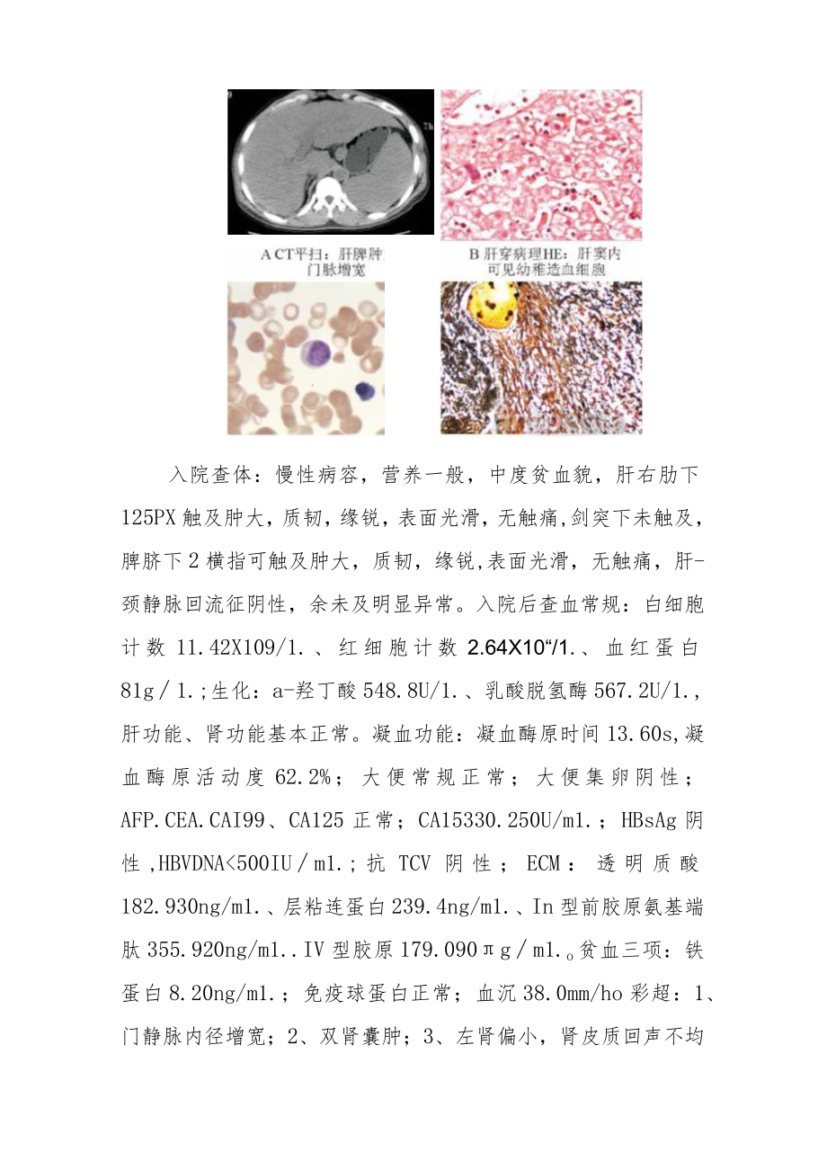 血液科科护士晋升副主任（主任）医师高级职称病例分析专题报告（骨髓纤维化诊断）.docx_第3页