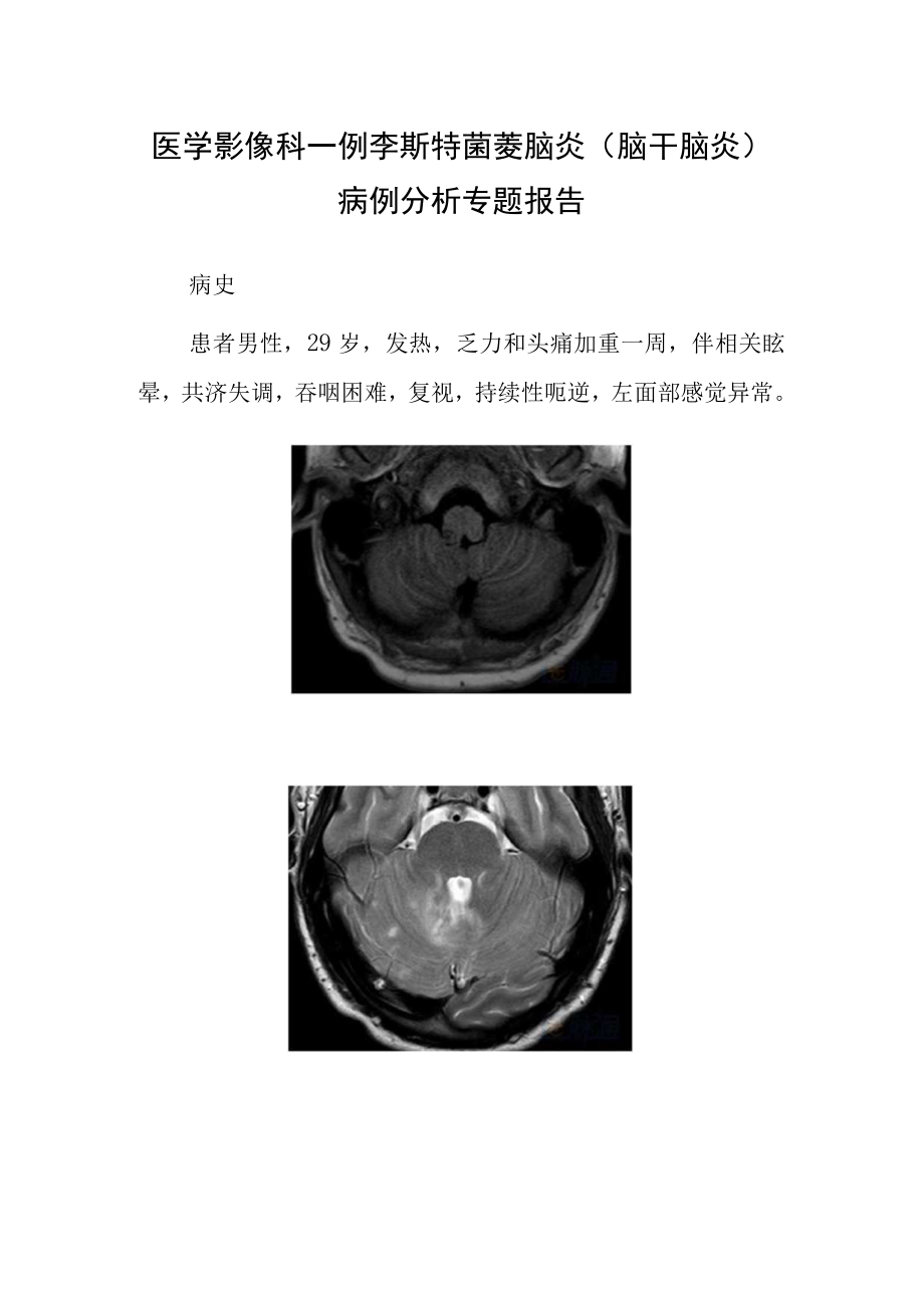 医学影像科李斯特菌菱脑炎（脑干脑炎）病例分析专题报告.docx_第1页