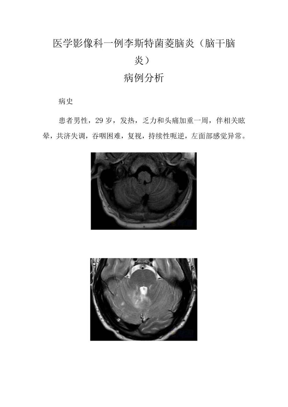 医学影像科医师晋升副主任（主任）医师高级职称病例分析专题报告（李斯特菌菱脑炎（脑干脑炎））.docx_第2页