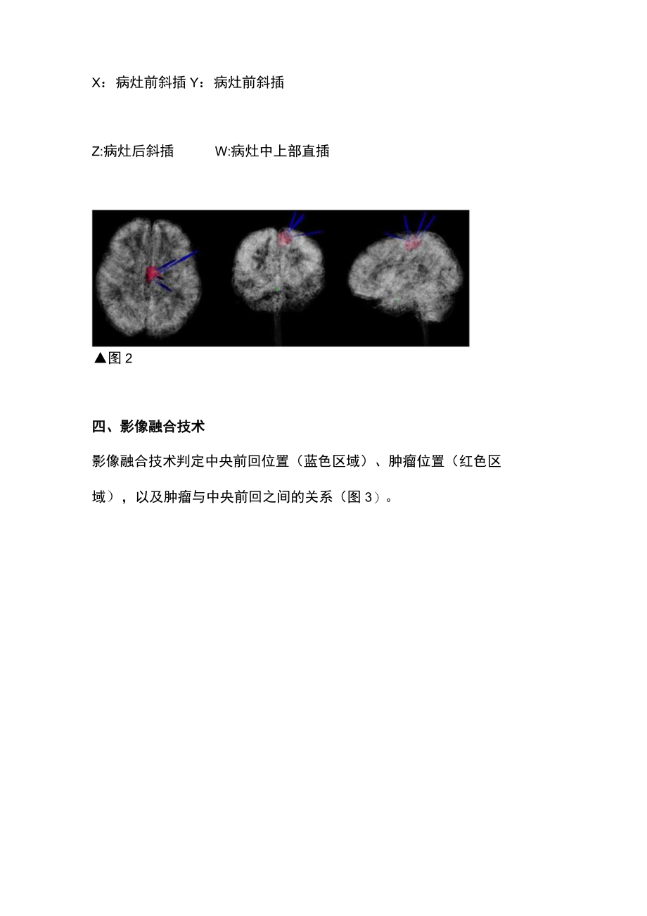 2022运动功能区肿瘤伴癫痫的手术治疗（全文）.docx_第3页