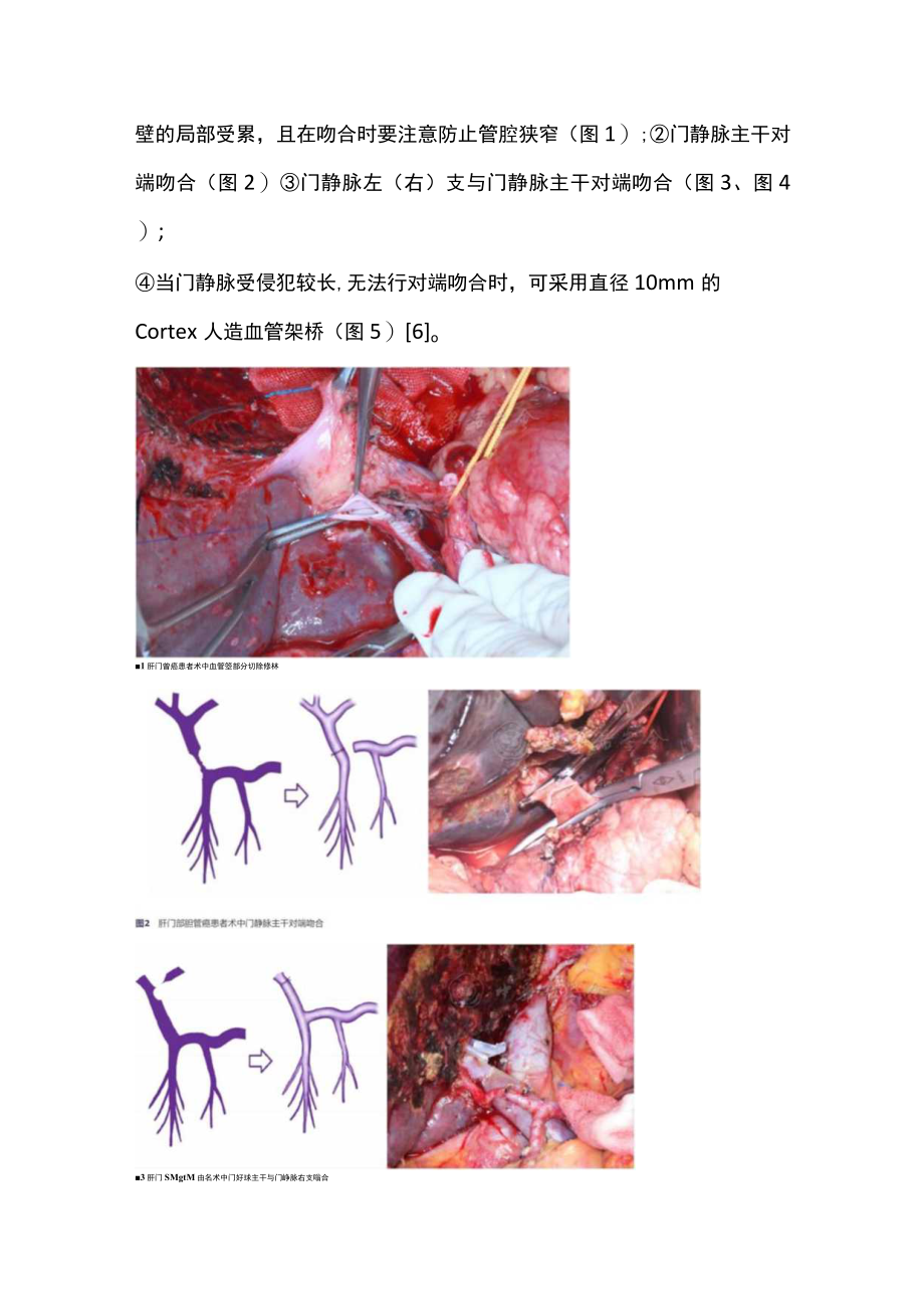 最新：肝门部胆管癌根治术中联合血管切除重建的技术(全文).docx_第3页