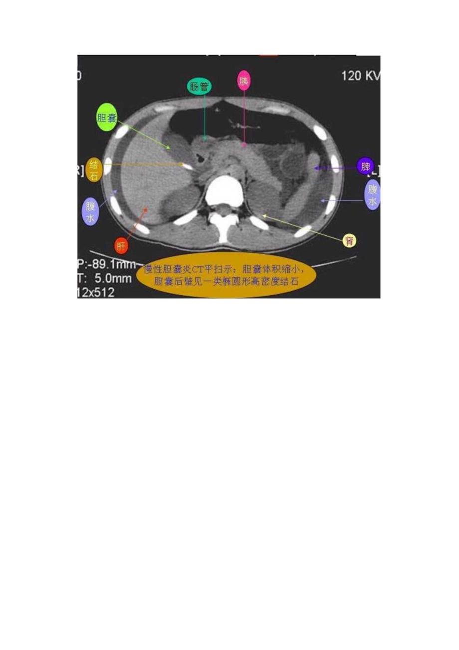 胆囊炎CT应用解剖.docx_第3页