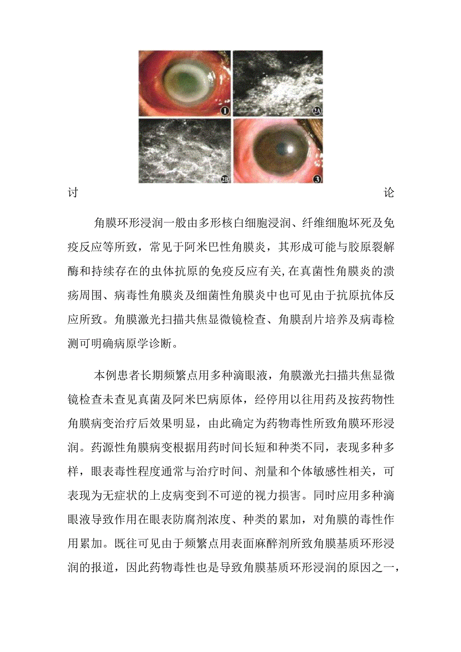 眼科一例药物性角膜环形浸润病例分析专题报告.docx_第2页