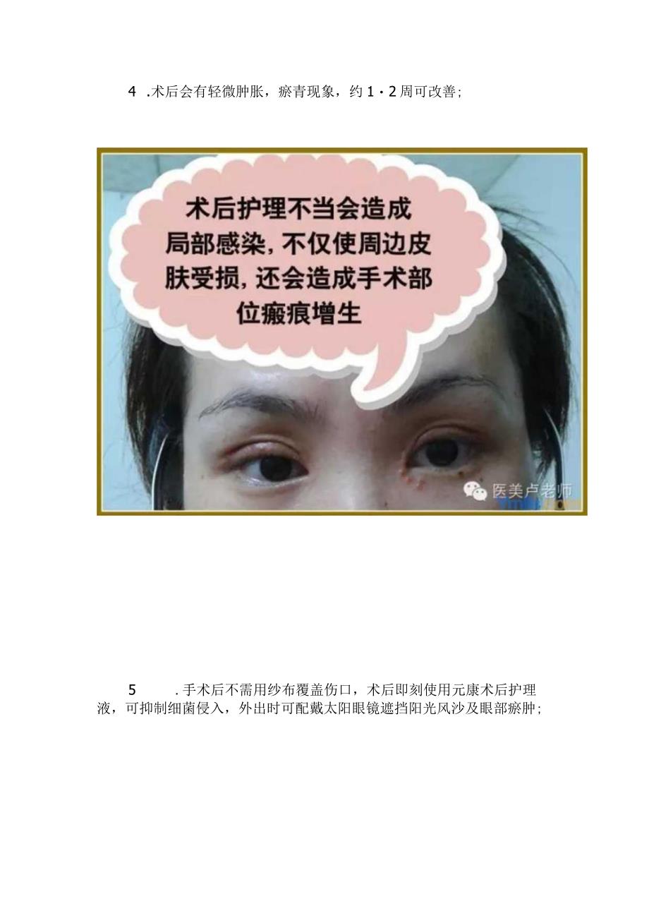 医美眼整形术后8项护理措施.docx_第2页