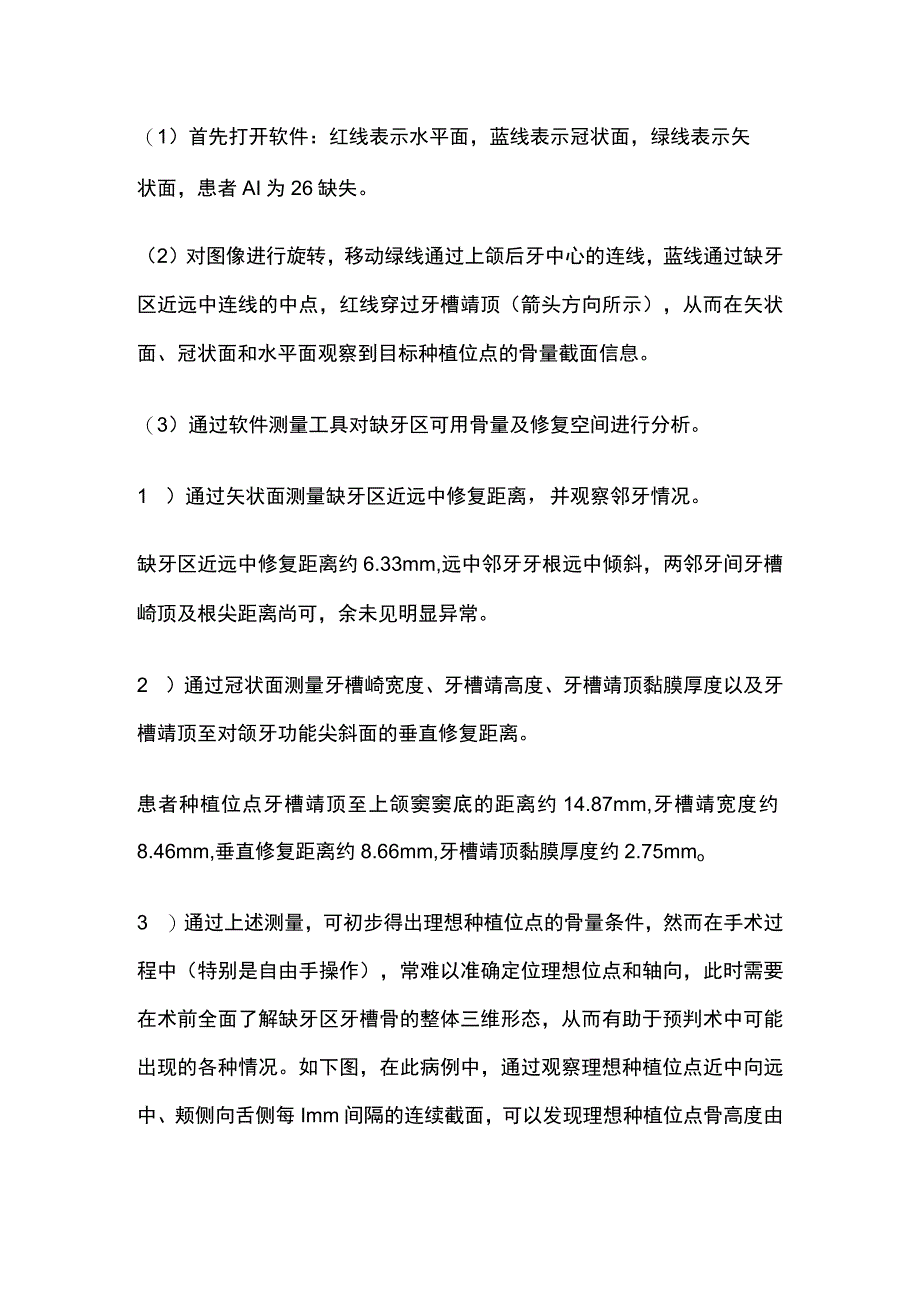 牙齿种植治疗方案的制定全.docx_第2页