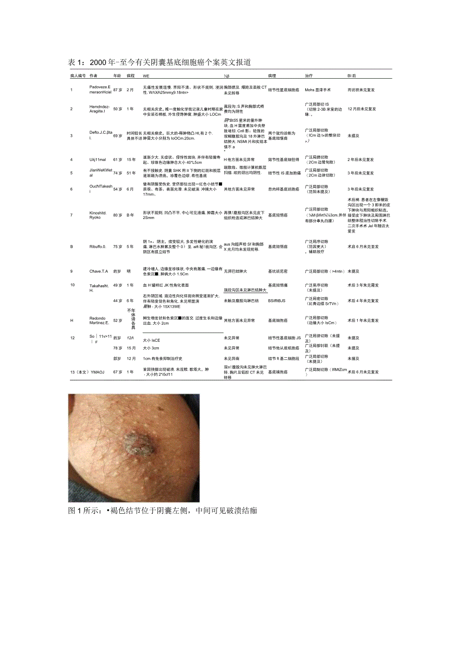 阴囊基底细胞癌1例并文献复习.docx_第2页