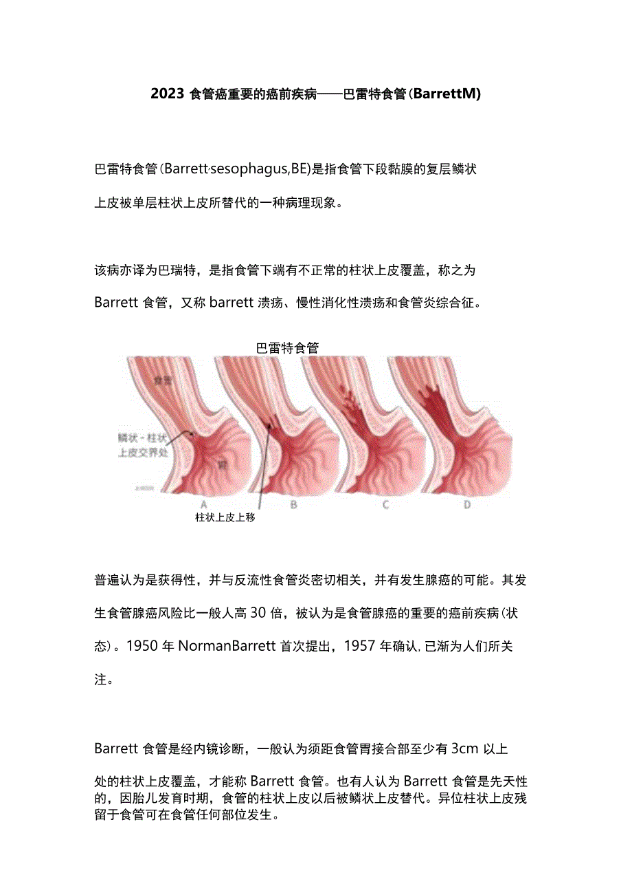 2023食管癌重要的癌前疾病——巴雷特食管（Barrett’s）.docx_第1页